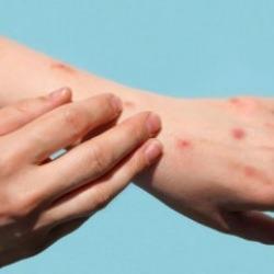 Sabri Ülker Vakfı, Maymun Çiçeği ile ilgili merak edilen soruları yanıtladı