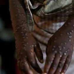 Maymun &Ccedil;i&ccedil;eği i&ccedil;in ilk aşıya onay verildi