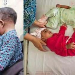 Cumhurbaşkanı Erdoğan talimat vermişti: Pakistanlı yapışık ikizler Türkiye'de ayrıldı!