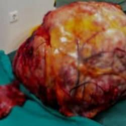 Hastanın karnından &ccedil;ıktı! Tam 26 kilo...