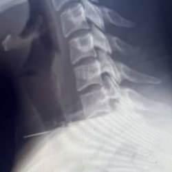 Baş&ouml;rt&uuml;s&uuml;n&uuml; takarken boğazına iğne saplandı!