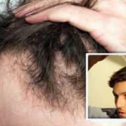 Kelliğe çare: Şeker jeli ile kelliğe çözüm