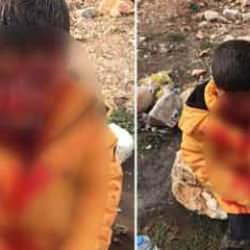 Adıyaman'da başıboş köpek dehşeti: 9 yaşındaki çocuk ağır yaralandı 