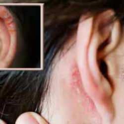 Kulaktaki bu yaygın cilt sorununu sakın göz ardı etmeyin!