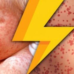 ABD’de kızamık salgını: Çocuklar ve gençler tehlikede!