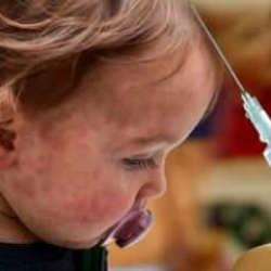 DSÖ’den Avrupa’da kızamık uyarısı: 27 yıl sonra en büyük vaka sayısı!