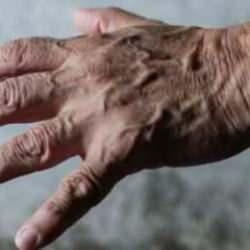 Ellerde beliren mavi damarlar hastalık habercisi mi?