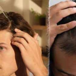 Saç dökülmesi yüzünden kelleşen bölgelerde Hint yağıyla saç çıkarın!