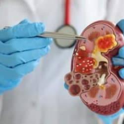 Sessizce ilerliyor, tesadüfen fark ediliyor! Böbreği korumak için bu risklerden kaçının