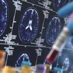 Bu kan testi her şeyi değiştirecek: Alzheimer artık erken evrede tespit edilebiliyor!