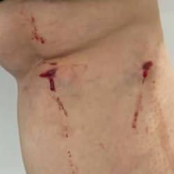 Üniversite kampüsünde başıboş köpeklerin saldırına uğrayan öğrenci yaralandı