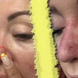 Sıradan bir sivilce sandı, ger&ccedil;ek ortaya &ccedil;ıkınca şoke oldu! O k&uuml;&ccedil;&uuml;k şişlik meğerse...