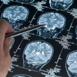 Alzheimer teşhisinde çığır açan gelişme: Yüzde 95 doğrulukla erken teşhis imkanı