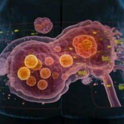 Kolon kanserinden bile sık görülüyor: Apandis kanseri patlaması!