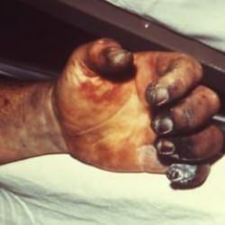 2025 yılında vebadan ölüm