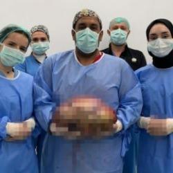 Şişlik yüzünden gittiği hastanede karnından 10 kilogram ağırlığında kitle çıkarıldı 