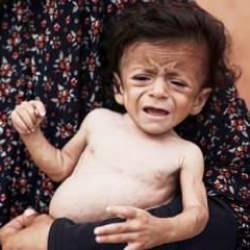 5 aylık Ammar açlıktan ölmek üzere