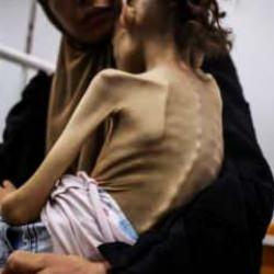 Gazze'de a&ccedil;lık krizi b&uuml;y&uuml;yor! 9 yaşındaki Meryem 10 kiloya d&uuml;şt&uuml;