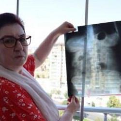 Ameliyat skandalı! 22 yıldır canlı bomba gibi geziyor 