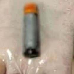 39 yaşındaki hastanın midesinden çıktı! Doktorlar bile şoke oldu