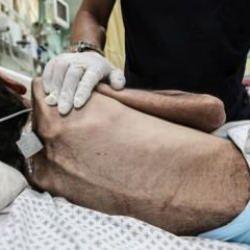 Gazze'de açlıktan ölenlerin sayısı 404'e yükseldi