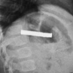 Anne babalar dikkat! 3 yaşındaki çocuğun boğazından çıkarıldı: Tam 19 tane