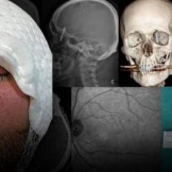 Diş tedavisi için gitti hayatı kâbusa döndü! Çenesini delip kafatasına saplandı