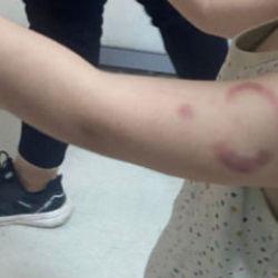 Kreşte kan donduran olay: Öğretmen çocuğun kolunu ısırdı