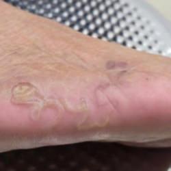 &Ccedil;ıplak ayak gezmek bile yasakalanmıştı: Rize&rsquo;deki bu hastalık 1980&rsquo;den beri g&ouml;r&uuml;lmedi