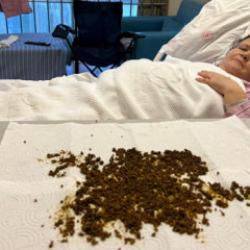 Doktorlar şoke eden vaka: Safra kesesinden 20 binin üzerinde taş çıktı! İşte o görüntü...