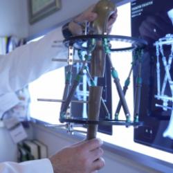 Boy kısalığında çığır açan tedavi: Günde 1 milimetre uzatan yöntem