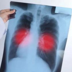 Akciğerinize kalıcı zarar veriyor! Siz de sık sık yaşıyorsanız dikkat