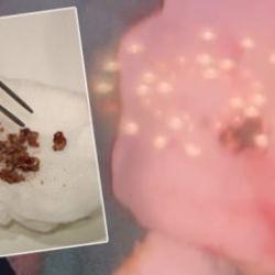 Yıllarca fark etmedi, estetik ameliyatta ortaya &ccedil;ıktı: Burunda rinolit şoku!