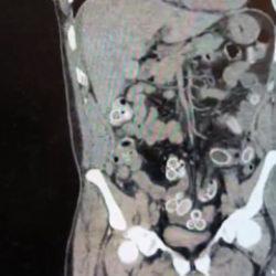 Fas&rsquo;tan Beşiktaş'a midesinde uyuşturucu getirdi: Ameliyatla &ccedil;ıkarıldı 