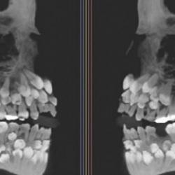 Tıp d&uuml;nyası şaşkın: 11 yaşındaki &ccedil;ocuğun 81 dişi olduğu tespit edildi!