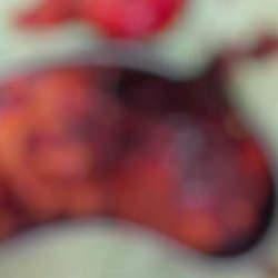 Şişkinlik şikayetiyle başvurdu, karnından 2 kilo 200 gram t&uuml;m&ouml;r &ccedil;ıktı