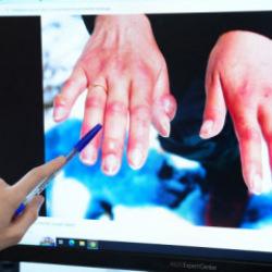 Kış geldi, risk arttı soğuk ısırığına dikkat