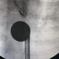 G&ouml;ren inanamadı! 8 yaşındaki &ccedil;ocuğun boğazından &ccedil;ıkartılan şaşırttı