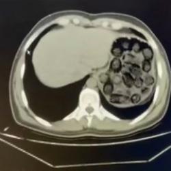 İranlı ş&uuml;phelilerin mide ve bağırsaklarından 91 kaps&uuml;l metamfetamin &ccedil;ıktı