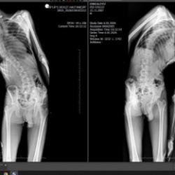 Mersin'de &ouml;nemli başarı: 18 yaşındaki gencin boyu ameliyatla 4 santimetre uzadı