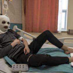 &Ccedil;akmak gazı faciası! V&uuml;cudu yandı