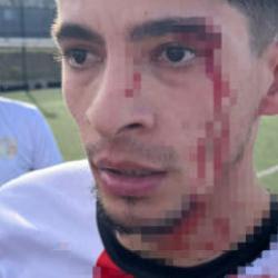 Yeşil sahada kan g&ouml;vdeyi g&ouml;t&uuml;rd&uuml;: 3 futbolcu hastanelik oldu