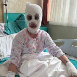 İftar hazırlığında facia: D&uuml;d&uuml;kl&uuml; tencere y&uuml;z&uuml;ne patladı!