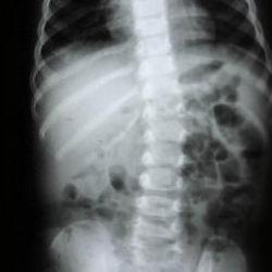 Omurga sağlığı i&ccedil;in nelere dikkat edilmeli? Uzman isim a&ccedil;ıkladı 