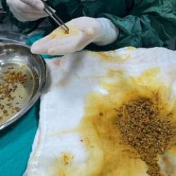 Karın ağrısı şikayetiyle gitti, v&uuml;cudundan 2 bin 67 tane taş &ccedil;ıktı