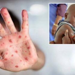 Nijerya'da kızamık salgını! &Ccedil;ok sayıda 15 &ccedil;ocuk &ouml;ld&uuml;