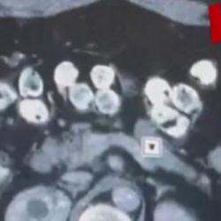 2 kilo 675 gram Afyon sakızı yuttuğu tespit edilen 3 ş&uuml;pheli tutuklandı