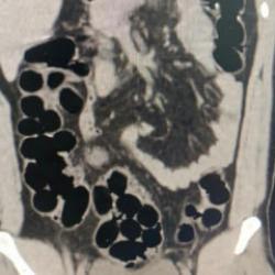 Midesinden kaps&uuml;ller i&ccedil;inde 943 gram eroin &ccedil;ıktı