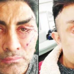 Gen&ccedil;leşmek istedi, hayatı kabusa d&ouml;nd&uuml;! 4 ameliyat oldu, g&ouml;zlerini kapatamıyor