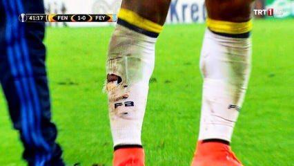 Fenerbahçeli yıldızın ayağı bu hale geldi!